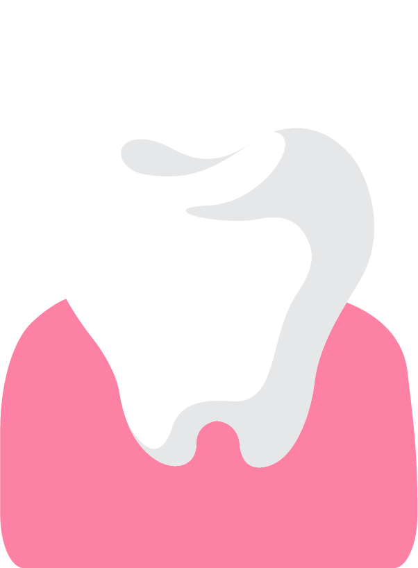 種牙費用 植牙價錢 傳統種牙 電腦導航微創種牙 Metro Dental